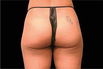 エムスカルプト女性-側面症例写真