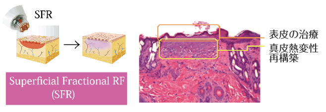 SFR Superficial Fractional RF 表皮の治療 真皮熱変性再構築