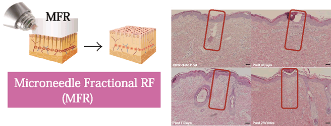 MFR Microneedle Fracional RF