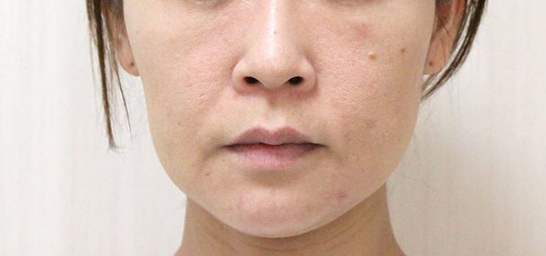 アンカースレッド2本・N-COGスレッド8本術前写真