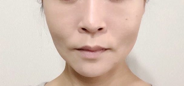 アンカースレッド2本・N-COGスレッド8本術後写真