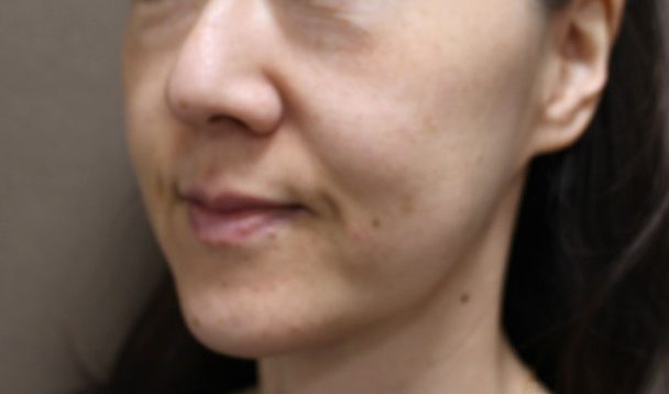 N-COGスレッド12本術前写真