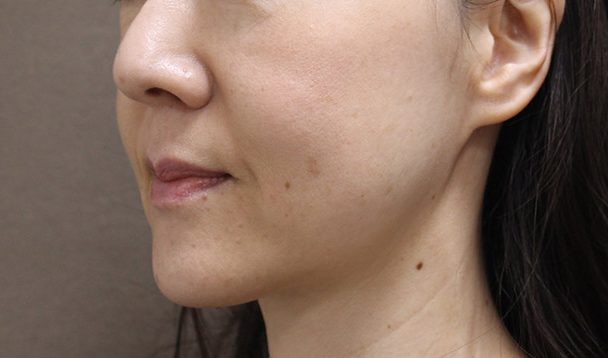 N-COGスレッド12本術後写真