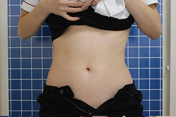 SUEクリニックのエムスカルプト女性-正面症例写真