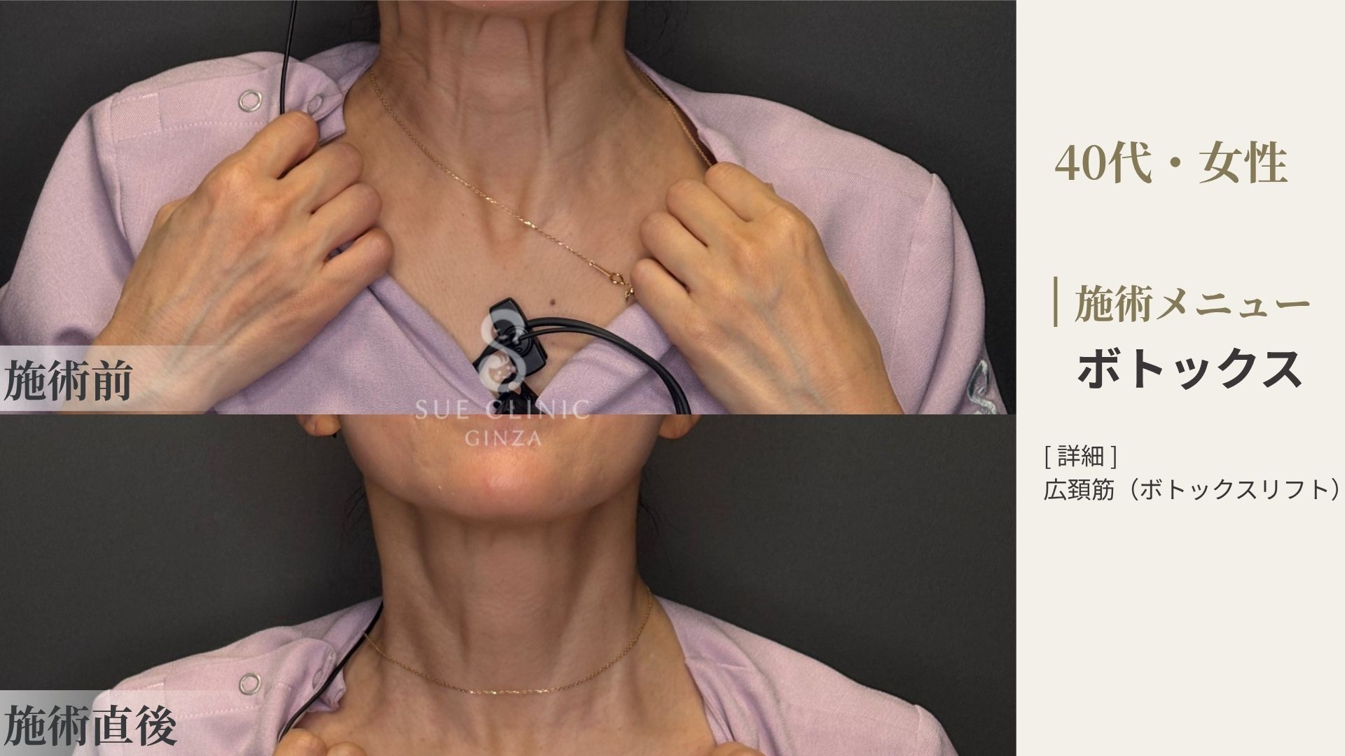 ボトックス施術の施術前と施術後の症例写真