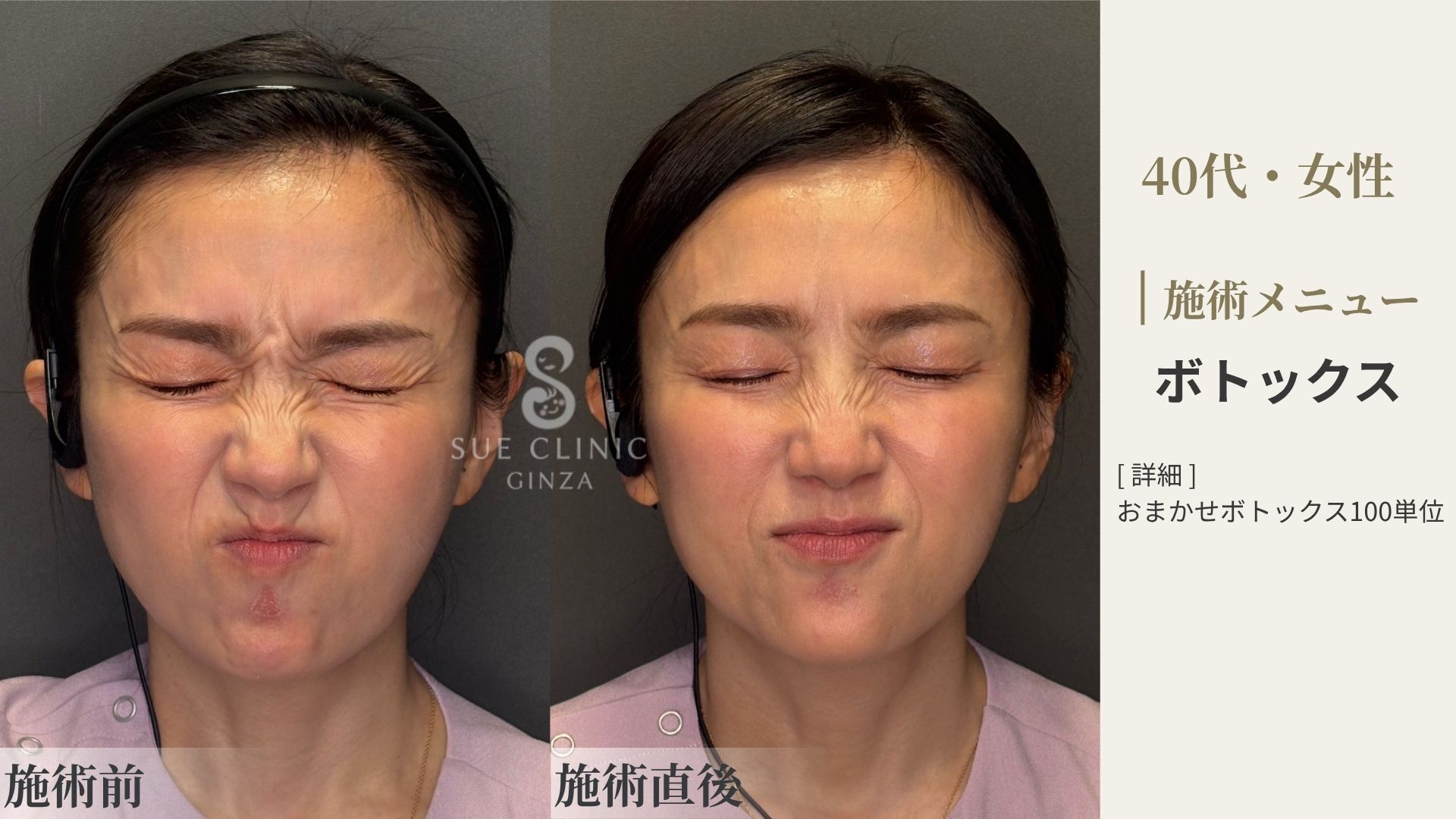 ボトックス施術の施術前と施術後の症例写真