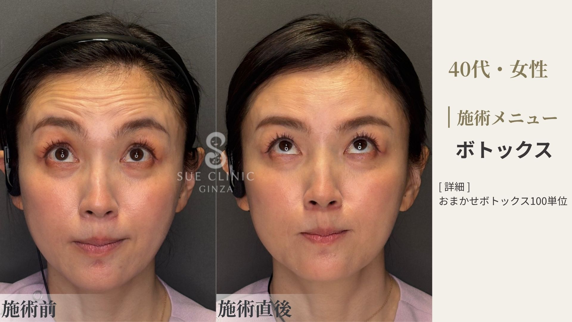 ボトックス施術の施術前と施術後の症例写真