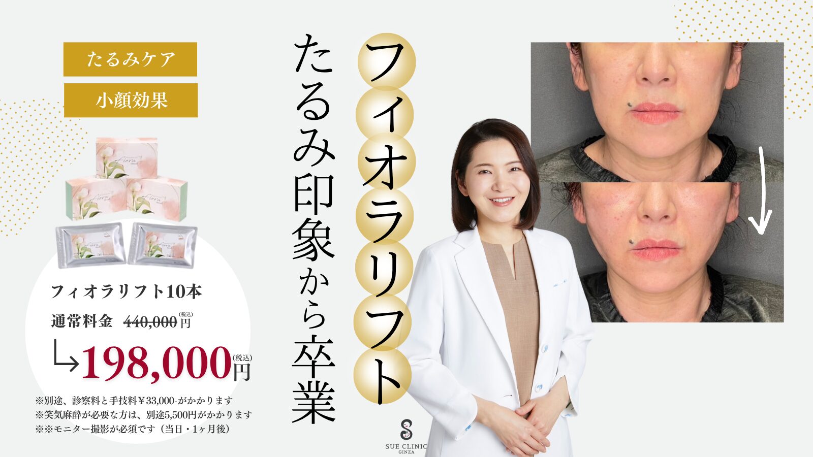 【金子医師施術】フィオラリフト