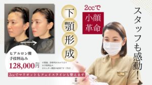 【金子医師施術】下顎形成（ヒアルロン酸注入）