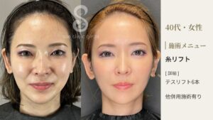 【症例写真】糸リフト(顔)