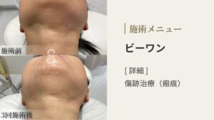 【症例写真】ビーワン