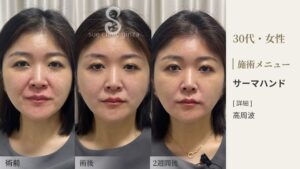 【症例写真】サーマハンド