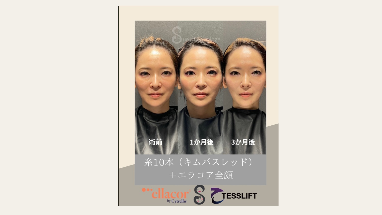 エラコア&糸リフト